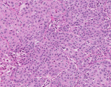 Carcinoma de células escamosas (CCE)
