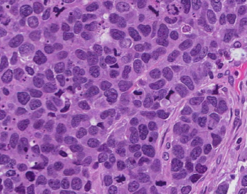 Carcinoma (indiferenciado)
de células grandes