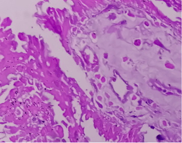 Adenocarcinoma